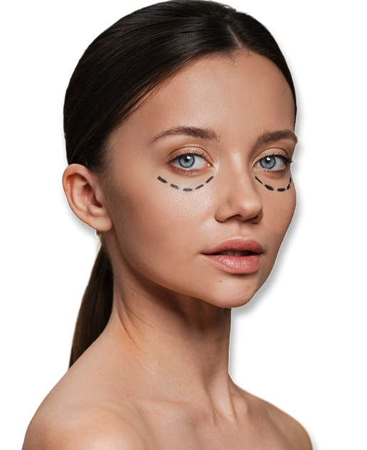 Блефаропластика— результат